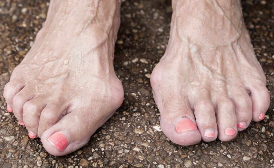 Bunions / Hammertoes